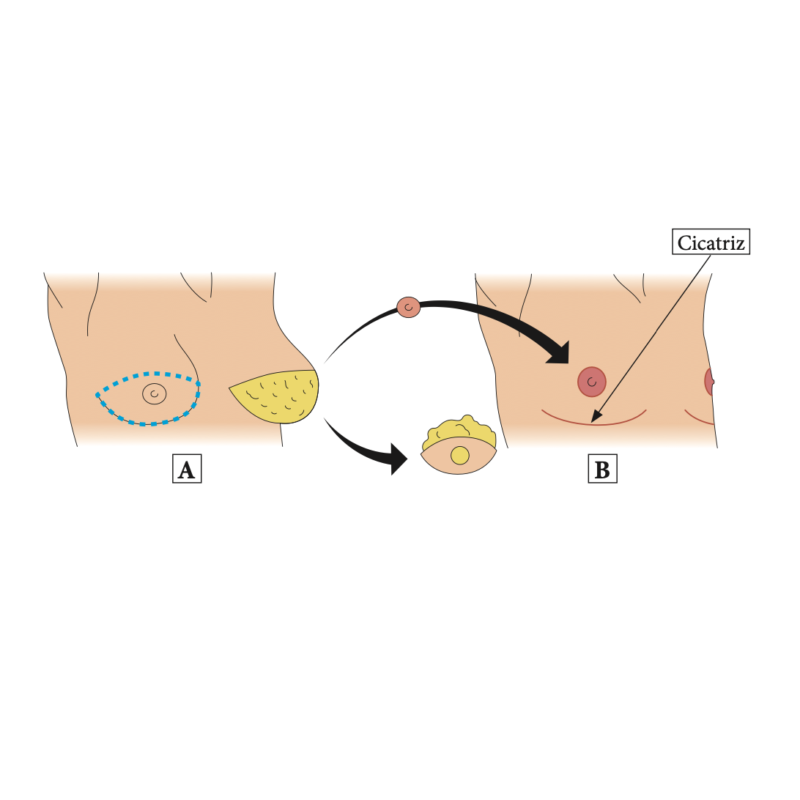 Consulta - Mastectomia Masculinizadora